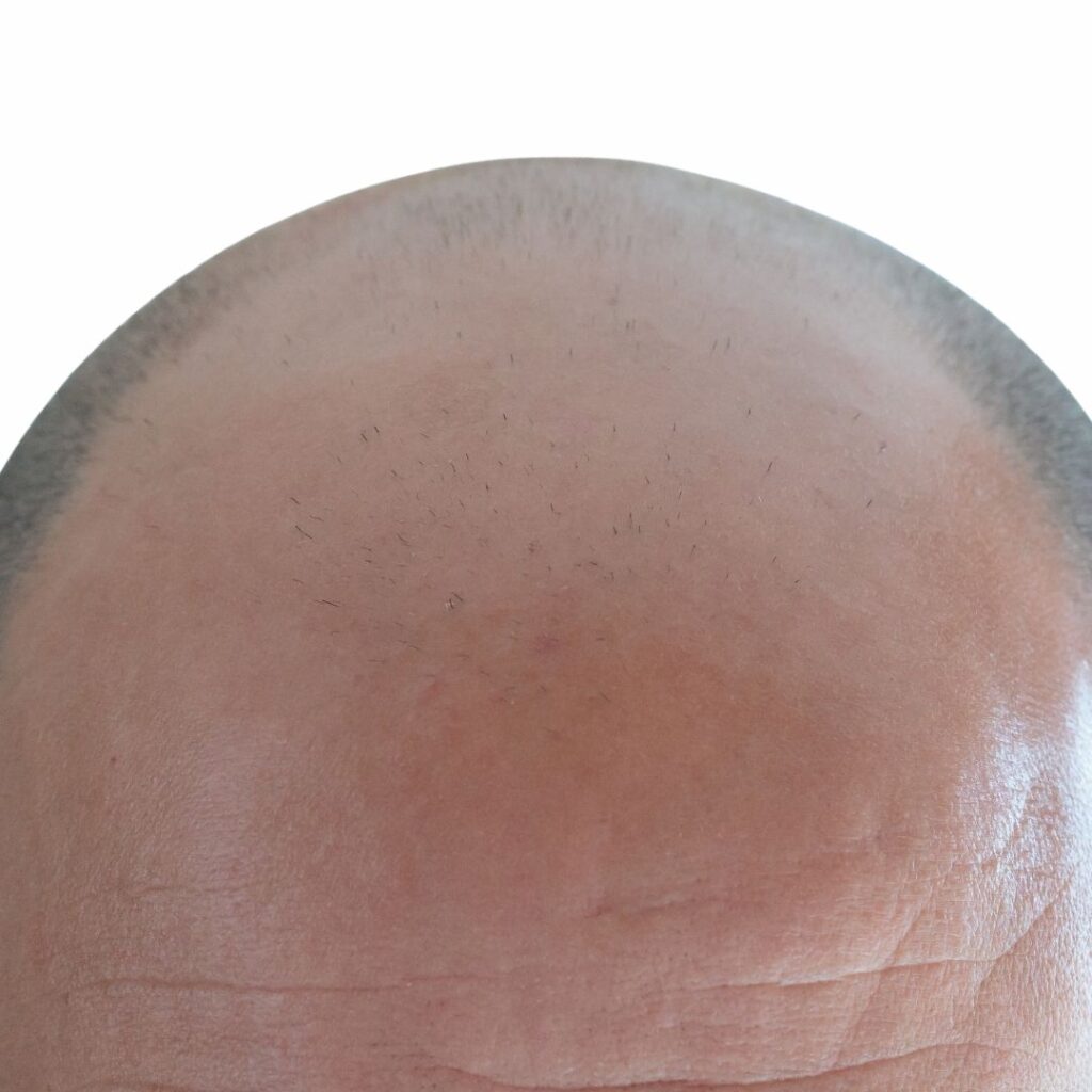 Vue rapprochée du cuir chevelu d’un client présentant des signes de calvitie, illustrant l’importance des consultations et devis personnalisés pour évaluer les besoins spécifiques en reconstruction capillaire et proposer un plan de traitement adapté | Esthetic For You à Theux.